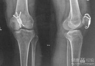 髌骨骨折下蹲训练视频,髌骨骨折康复下蹲训练方法详解